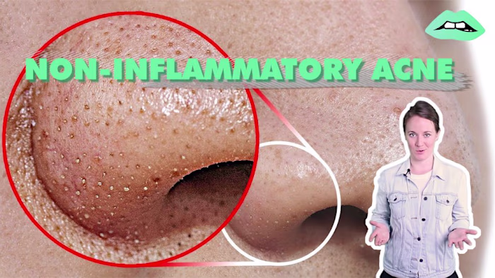 Case Study: Curology Native Advertising Campaign