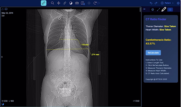 Working on OHIF DICOM Images Viewer and created Cardio Thora...