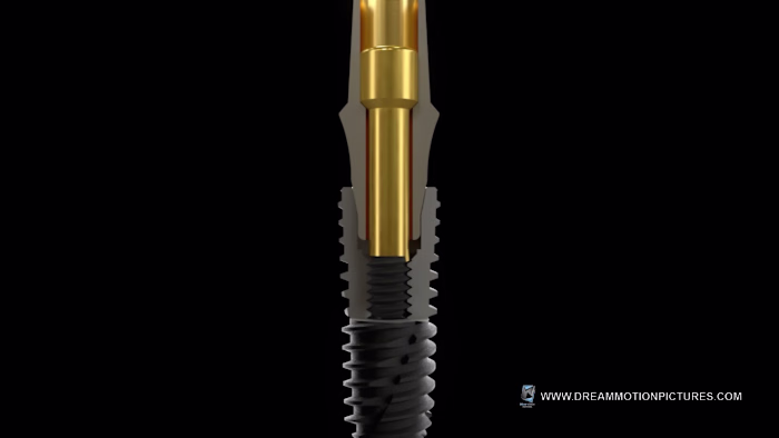 Innovative Dental Implant Material Animation