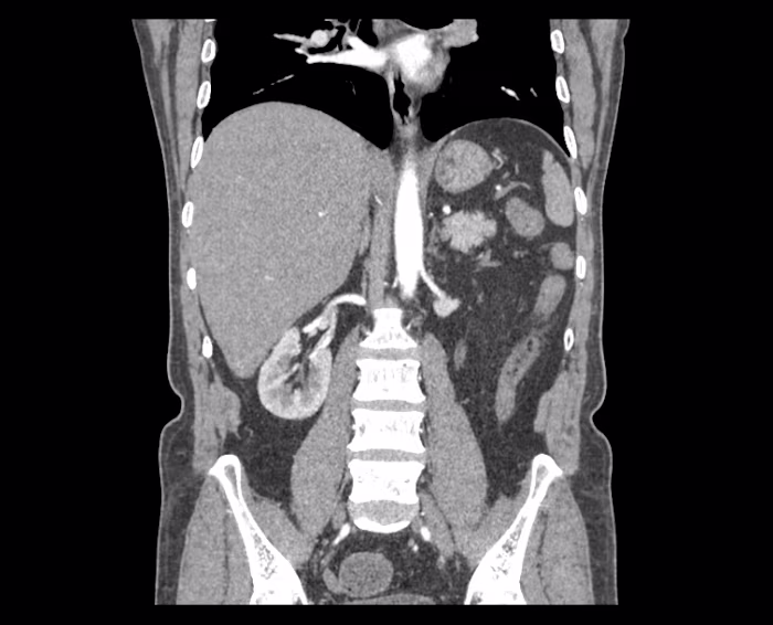 End-to-end pipeline for kidney disease classification 