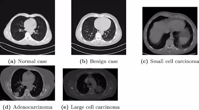 Lung Tumor Detection and Recognition Using Deep Learning in CNN