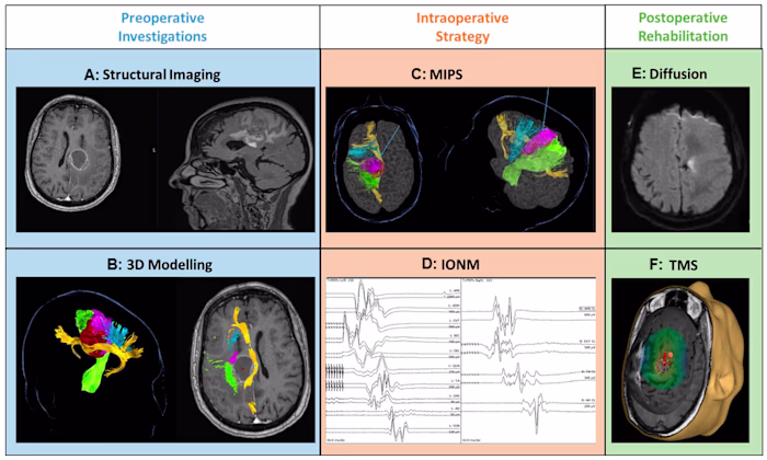 3D MultiModal MRI Segmentation