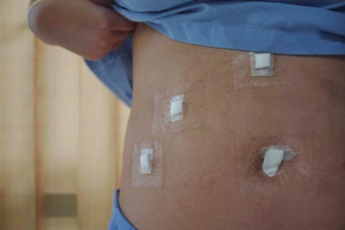 What to Expect from a Laparoscopic Cholecystectomy