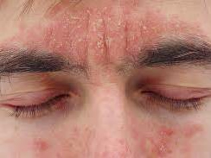 Understanding Seborrheic Dermatitis – Octaskin