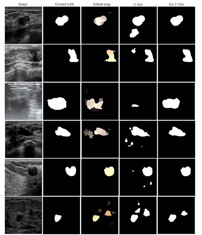 Breast-Tumor-Segmentation-in-Ultrasound-Images