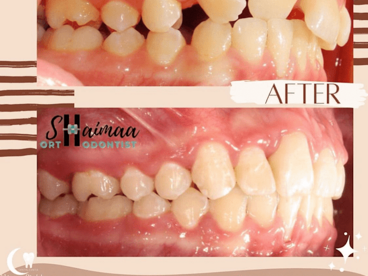Cover image for @moonlightdentalcenter on Instagram‎: ”عدم انتظام الأسنان قد ي…