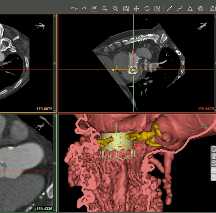 Cover image for Mitral Valve Planner