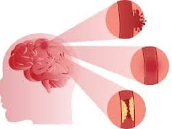 Cover image for STROKE - MosiPhysio