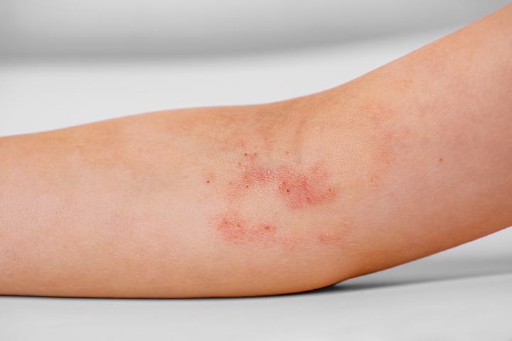 Cover image for Atopic Dermatitis: A Personalized Approach May Improve Outcomes
