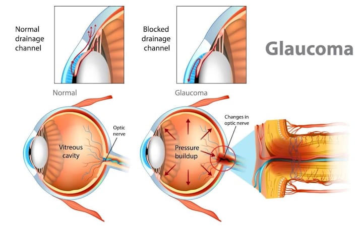 Cover image for Glaucoma Empowerment Guide: Symptoms, Causes, and Treatment