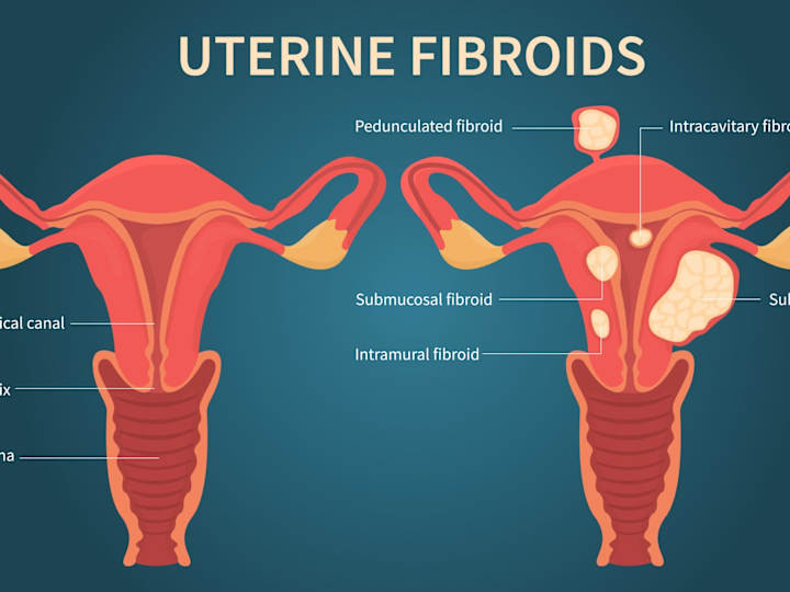 Cover image for Understanding Different Types of Fibroids 