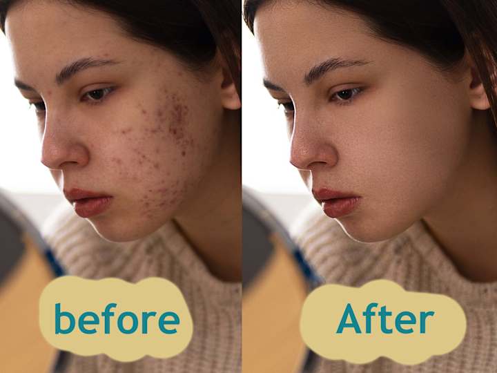 Cover image for blemishes and acne (rosacea) removal | skin retouching