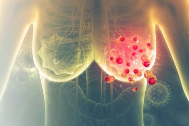 Cover image for Top Warning Signs of Breast Cancer