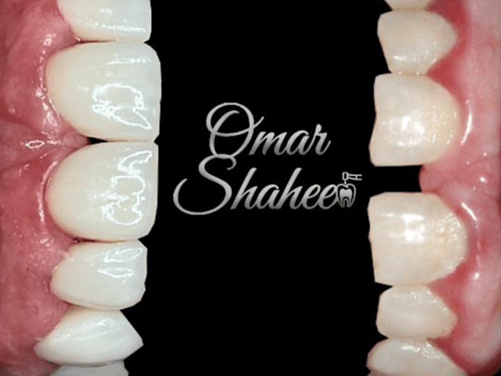 Cover image for Dentika on Instagram‎: “Perfectionism , the photo speaks for it…