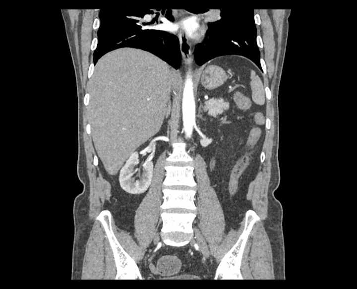 Cover image for End-to-end pipeline for kidney disease classification 