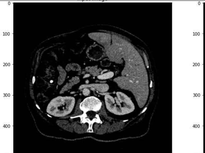 Cover image for Advanced U-Net Model for Liver and Liver Tumor Identification