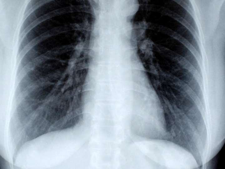 Cover image for Pneumonia Classification for Covid-19