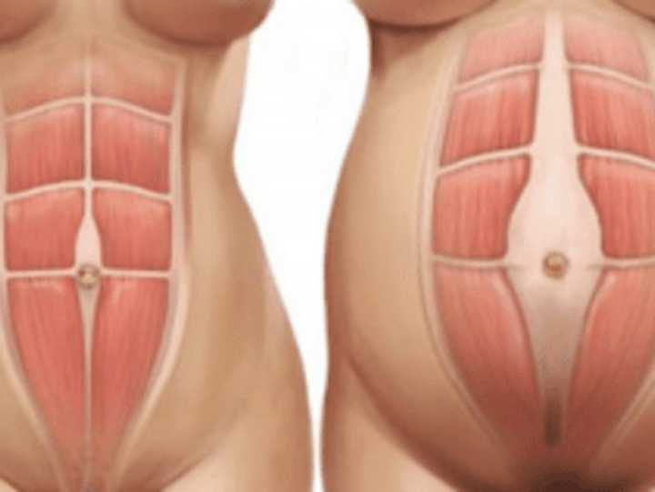 Cover image for Abdominal Separation Blog