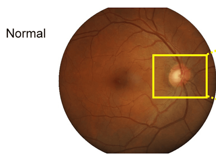 Cover image for Glaucoma detection