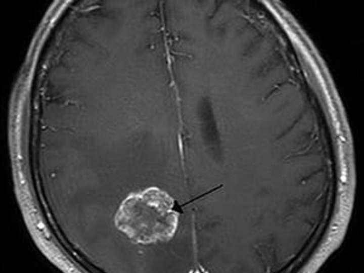 Cover image for BRAIN TUMOR - MosiPhysio
