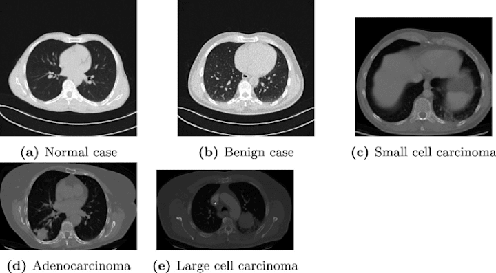 Cover image for Lung Tumor Detection and Recognition Using Deep Learning in CNN