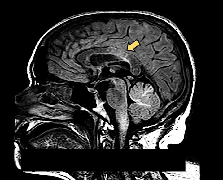 Cover image for Death following rapidly progressive demyelinating disorder in a…