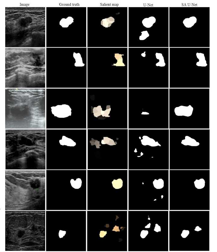 Cover image for Breast-Tumor-Segmentation-in-Ultrasound-Images