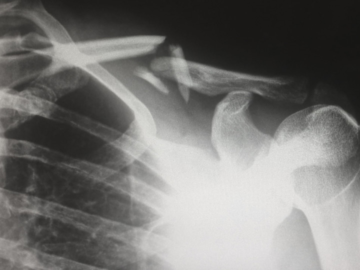 Cover image for What Injuries Do Robert J. DeBry Car Accident Lawyers Accept?