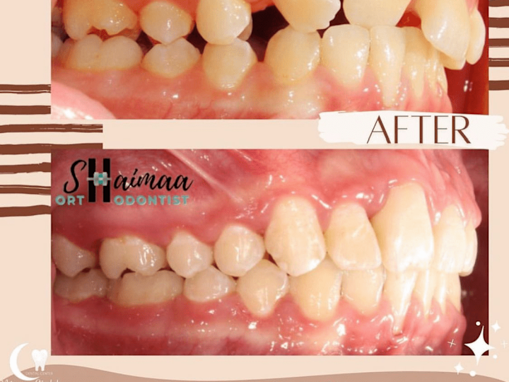 Cover image for @moonlightdentalcenter on Instagram‎: ”عدم انتظام الأسنان قد ي…