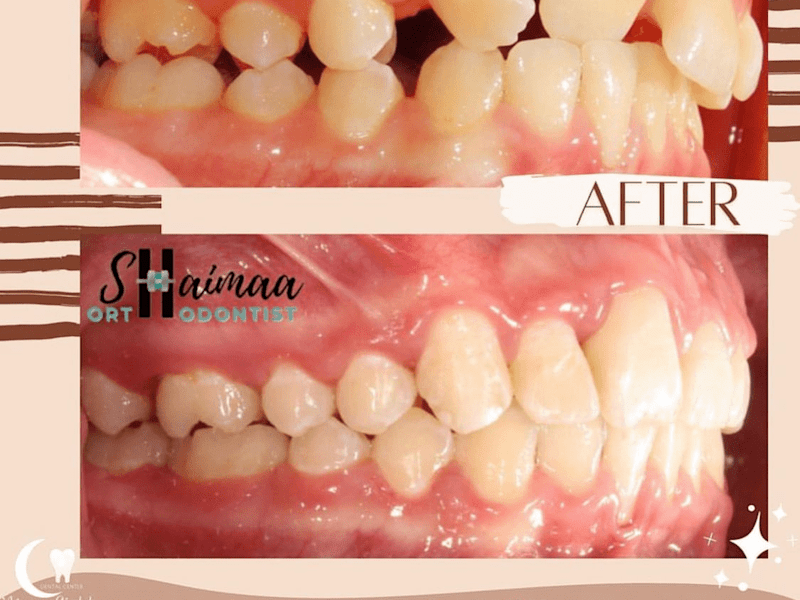 Cover image for @moonlightdentalcenter on Instagram‎: ”عدم انتظام الأسنان قد ي…