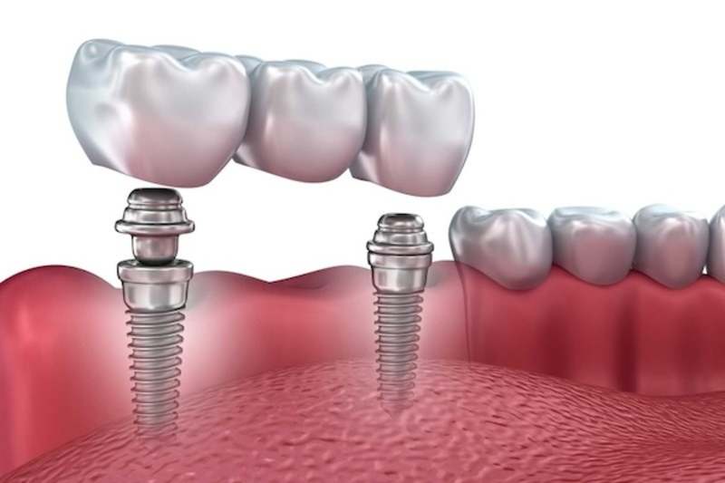 Cover image for How long can it take to adjust to dental implants? | Excel Dent…