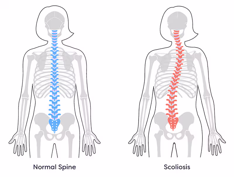 Cover image for Title: Scoliosis awareness 3000% ROAS Client: SKMC Hospital ...