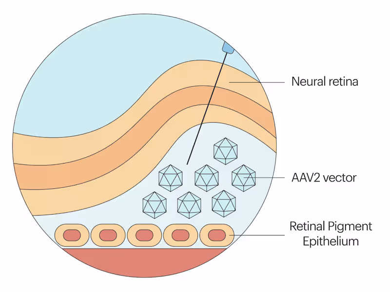 Cover image for Retinitis Pigmentosa - Gene Therapy Treatment