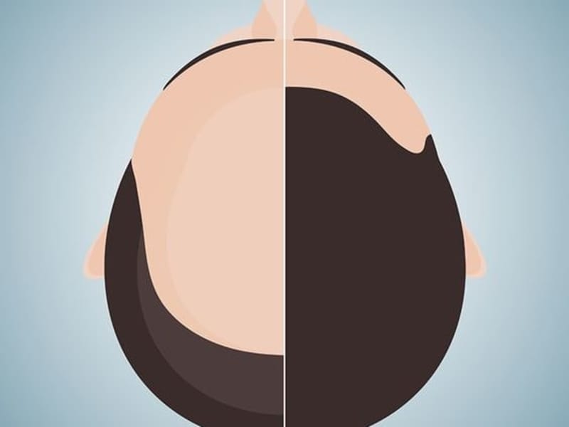 Cover image for Hair Transplant