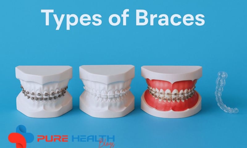 Cover image for Comprehensive Guide to Dental Braces