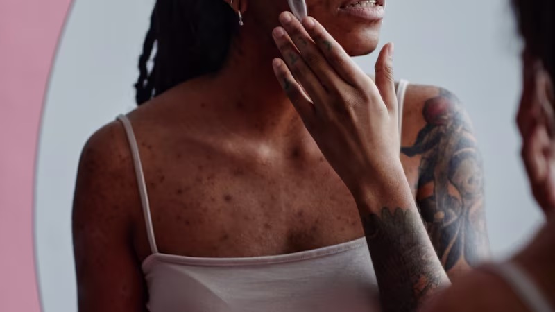 Cover image for Are You Having A Hormonal Or Bacterial Breakout? How To Tell The