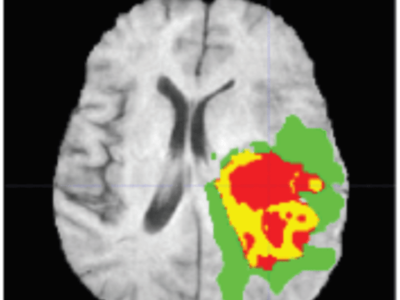 Cover image for Brain Tumor Segmentation Using U-Nets