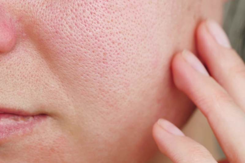 Cover image for How to Minimize Enlarged Pores: Best Products and Tips for Smoo…