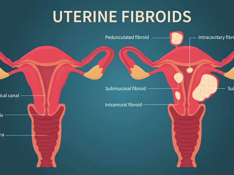 Cover image for Understanding Different Types of Fibroids 