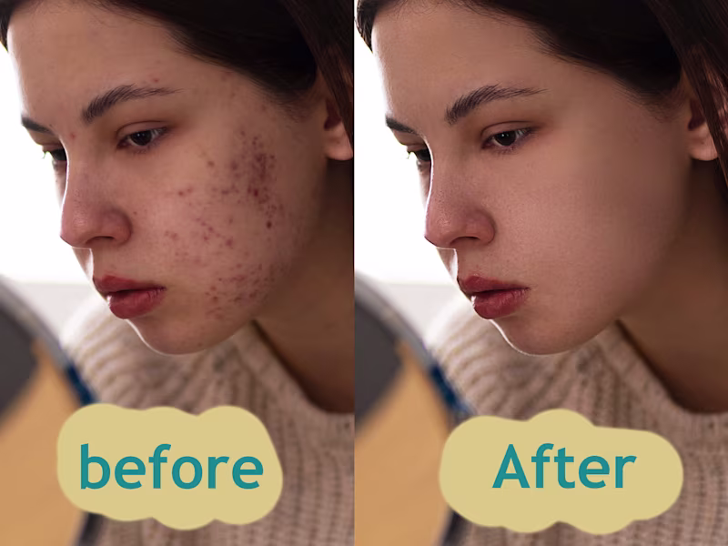 Cover image for blemishes and acne (rosacea) removal | skin retouching