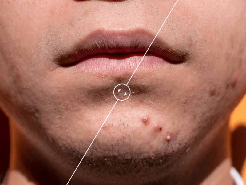 Cover image for Blemish Removal (Sample)