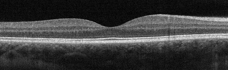 Cover image for Article: “OCT: The Intermarriage Between Imaging and Sampling.”