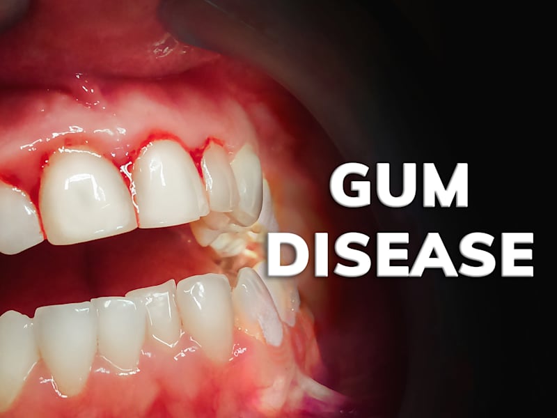 Cover image for Gum Disease Video Sales Letter