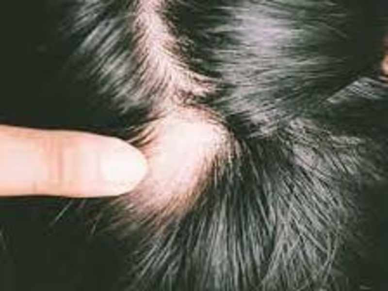 Cover image for Alopecia areata