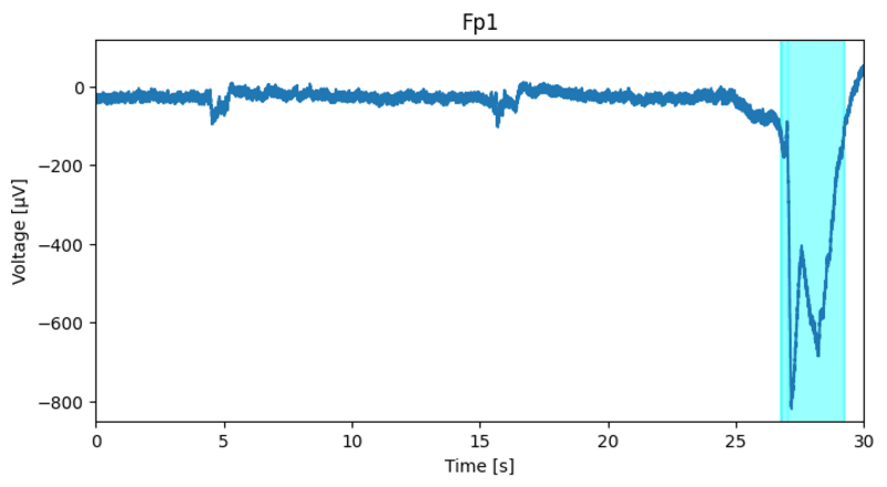 Cover image for Probabilistic Classification of Epileptic Patterns