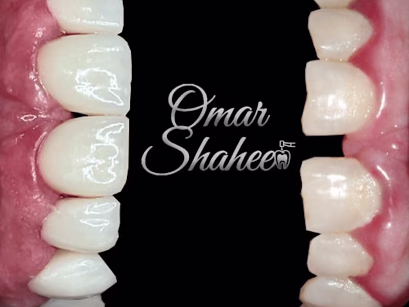 Cover image for Dentika on Instagram‎: “Perfectionism , the photo speaks for it…