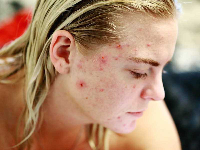 Cover image for How to get clear skin in 2023 