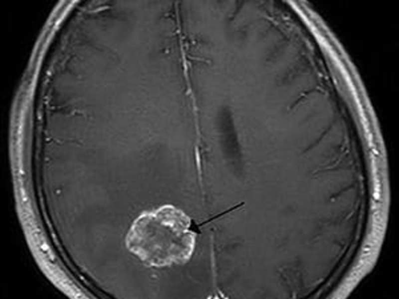Cover image for BRAIN TUMOR - MosiPhysio