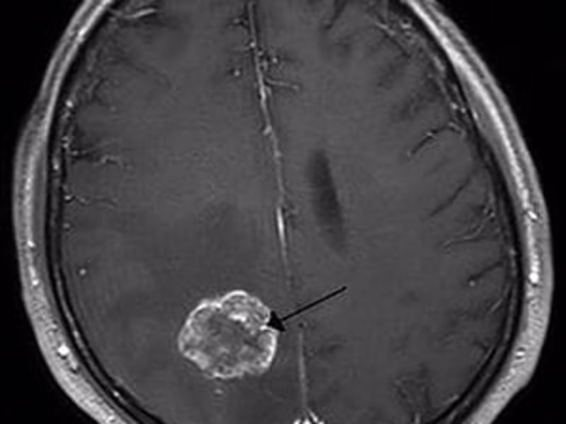 Cover image for BRAIN TUMOR - MosiPhysio