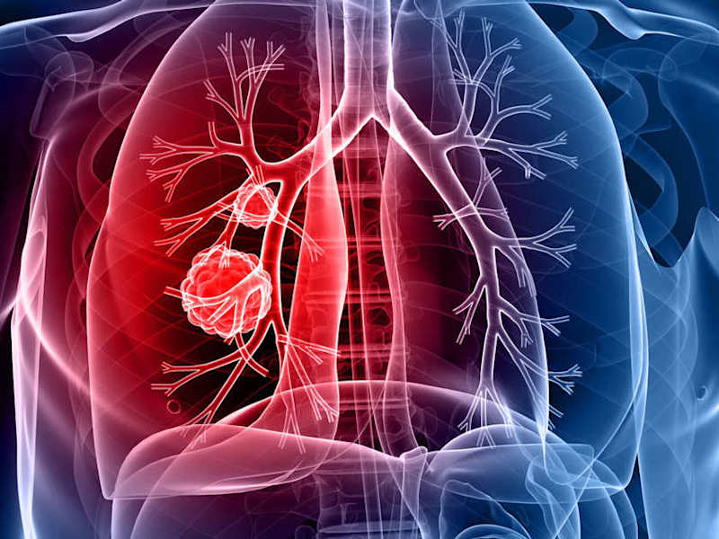 Cover image for samrat0033/Lung_Cancer_Prediction